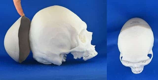 3d-systems-achieves-510k-clearance-for-peek-cranial-implants-1 3D Systems Achieves 510(k) Clearance for PEEK Cranial Implants